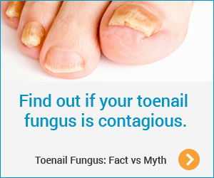 Toenail Fungus - Fact vs Myth